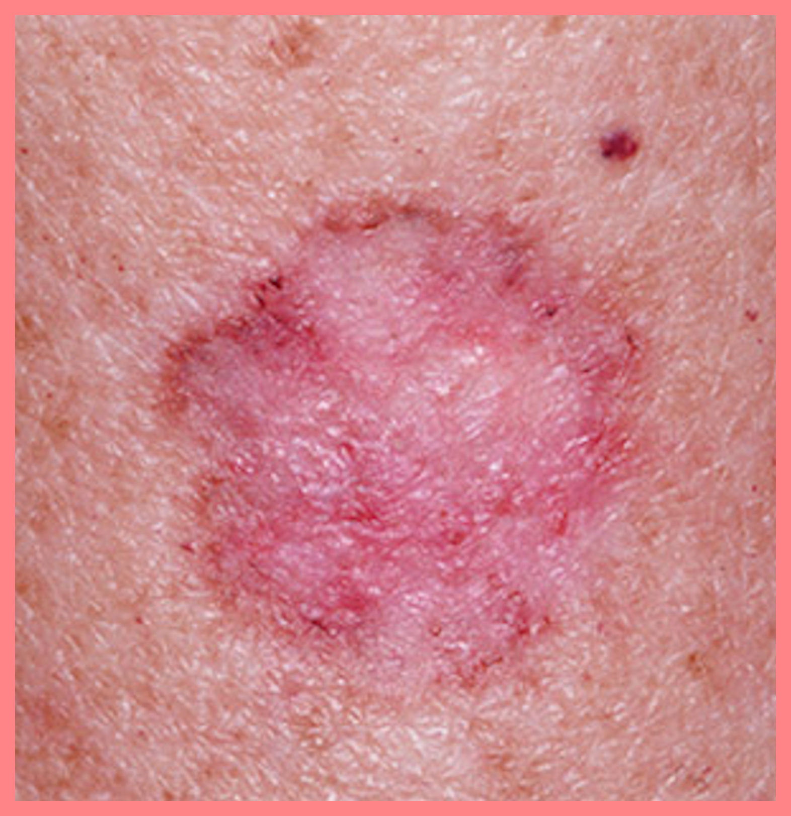 skin disease picture